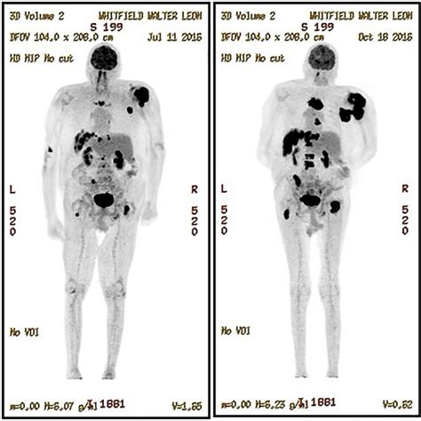Advanced Imaging Center at the Villages Whole Body PET Scan .